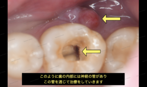 歯茎の白い出来物の腫れの治し方・根管治療や外科治療